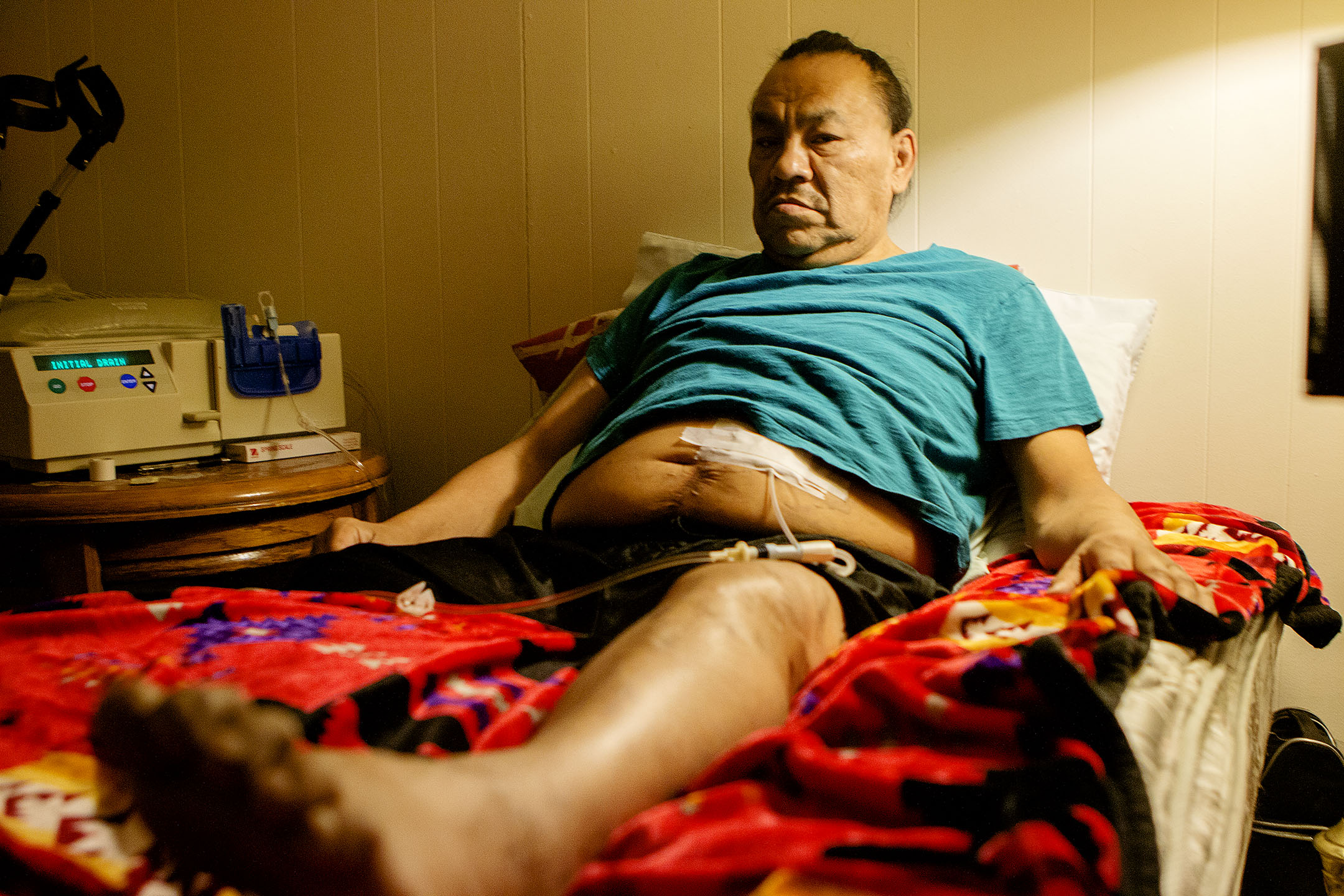 Jay Red Woman is a home dialysis patient living in Ashland, just outside of the Northern Cheyenne reservation. He says home dialysis is liberating for him because he is able to dialyze while he sleeps.